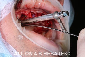 имплантация all-on-4 операция имплантация all-on-4 операция